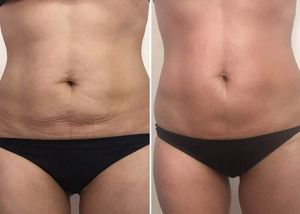 Soin NeoCare Elite body contouring, technologie minceur à l'Institut Massage Home